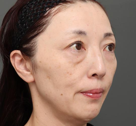 50代女性のボルニューマー Before 症例写真