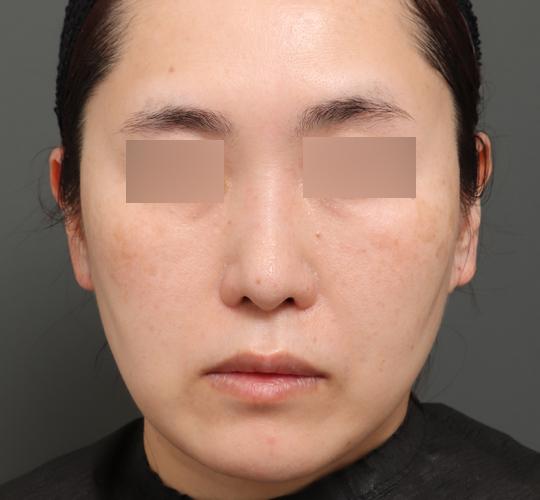 40代女性のエラ・アゴ・小顔 After 症例写真