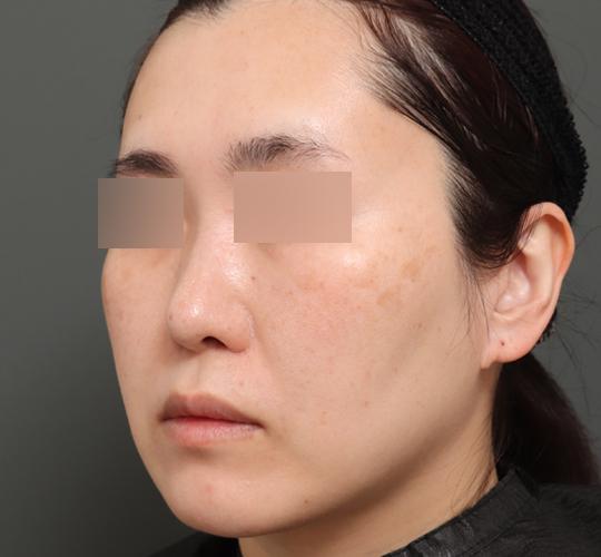 40代女性のボルニューマー After 症例写真