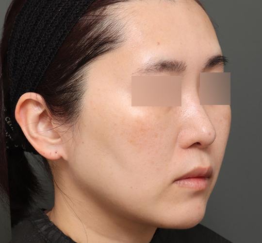 40代女性のボルニューマー After 症例写真