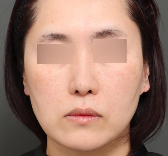 40代女性のエラ・アゴ・小顔 Before 症例写真