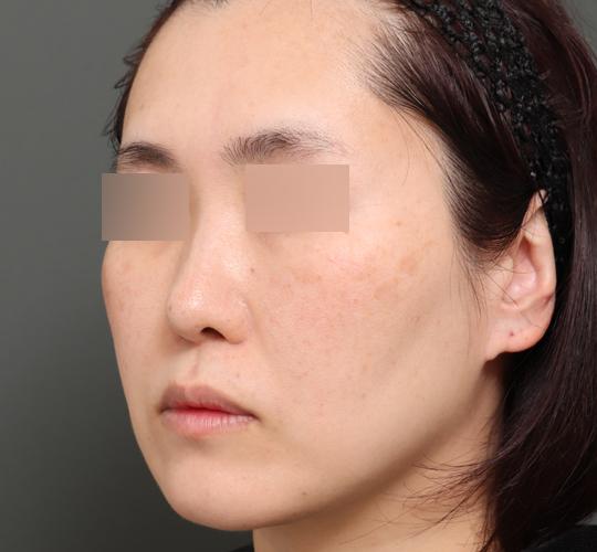 40代女性のボルニューマー Before 症例写真