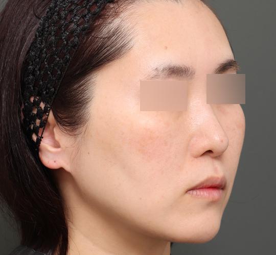 40代女性のボルニューマー Before 症例写真