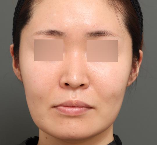 30代女性のボルニューマー After 症例写真