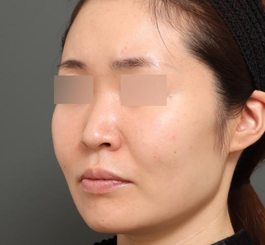 30代女性のエラ・アゴ・小顔 After 症例写真
