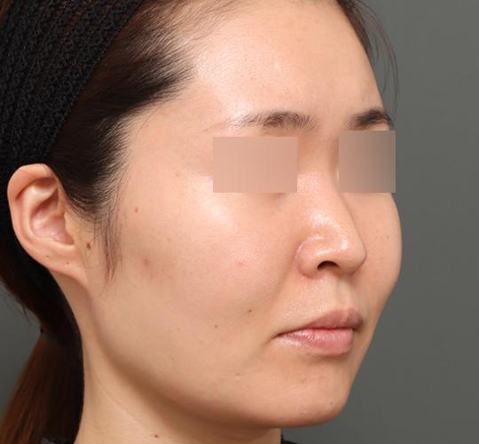 30代女性のボルニューマー After 症例写真