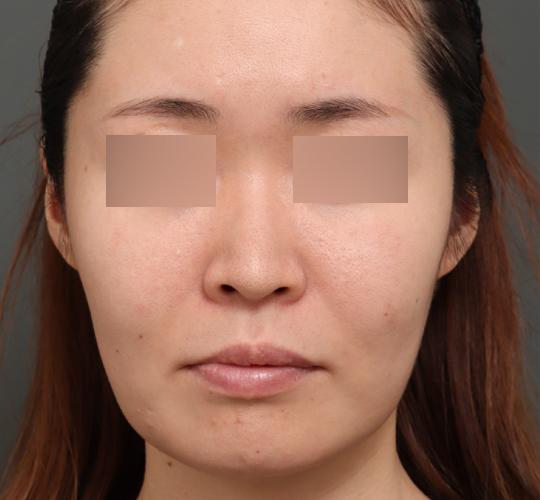 30代女性のボルニューマー Before 症例写真