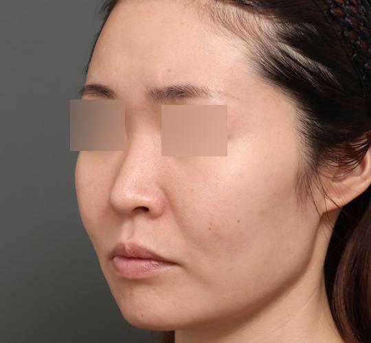 30代女性のエラ・アゴ・小顔 Before 症例写真