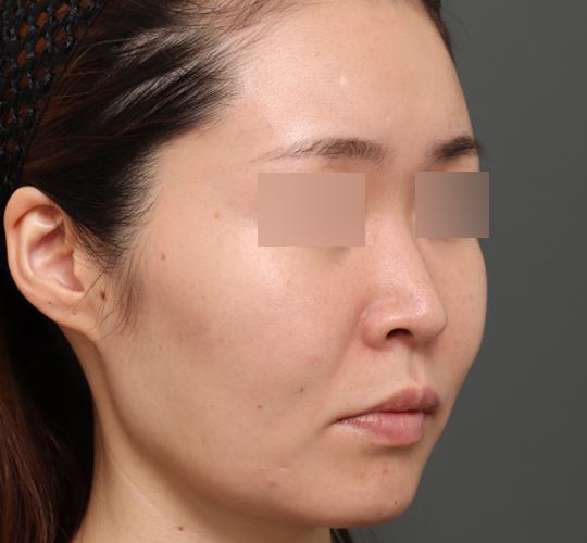 30代女性のボルニューマー Before 症例写真