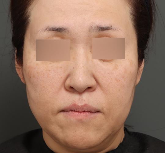 50代女性のボルニューマー After 症例写真