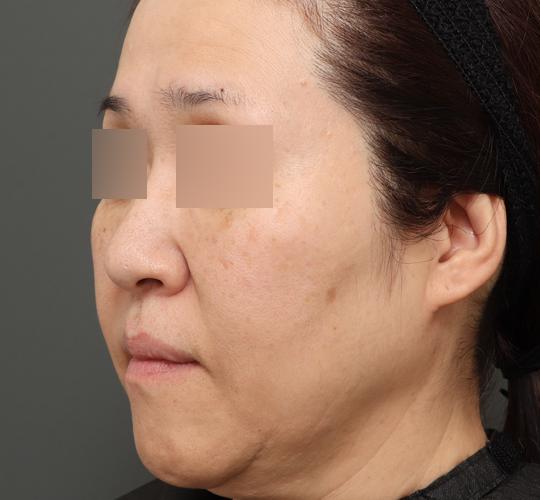 50代女性のエラ・アゴ・小顔 After 症例写真