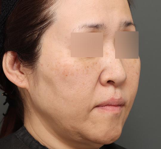 50代女性のボルニューマー After 症例写真