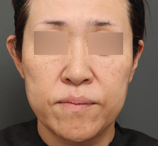 50代女性のボルニューマー Before 症例写真