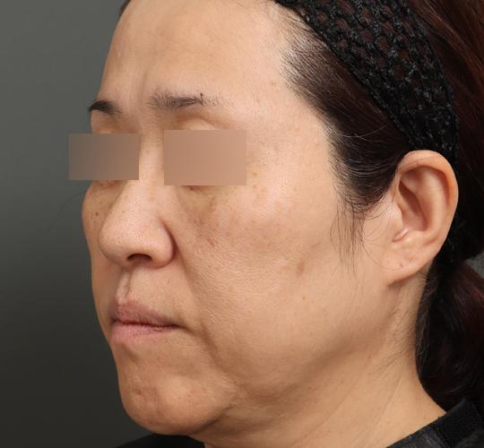 50代女性のエラ・アゴ・小顔 Before 症例写真