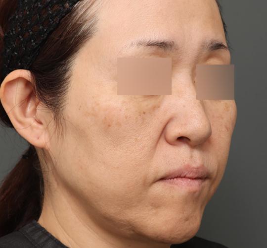 50代女性のボルニューマー Before 症例写真