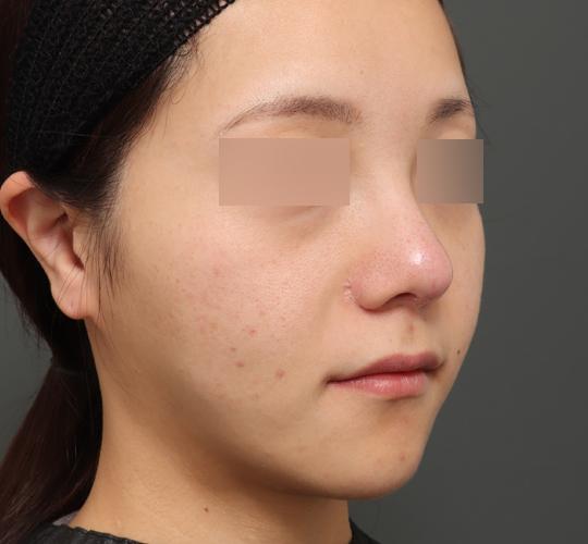 30代女性のボルニューマー After 症例写真