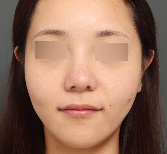 30代女性のボルニューマー Before 症例写真