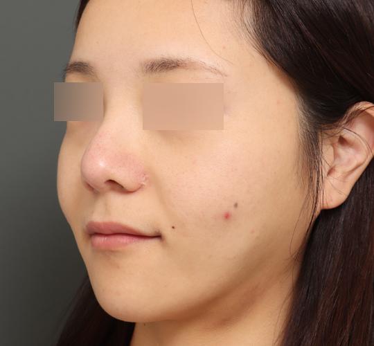 30代女性のエラ・アゴ・小顔 Before 症例写真