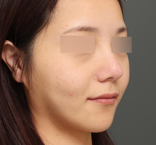 30代女性のボルニューマー Before 症例写真