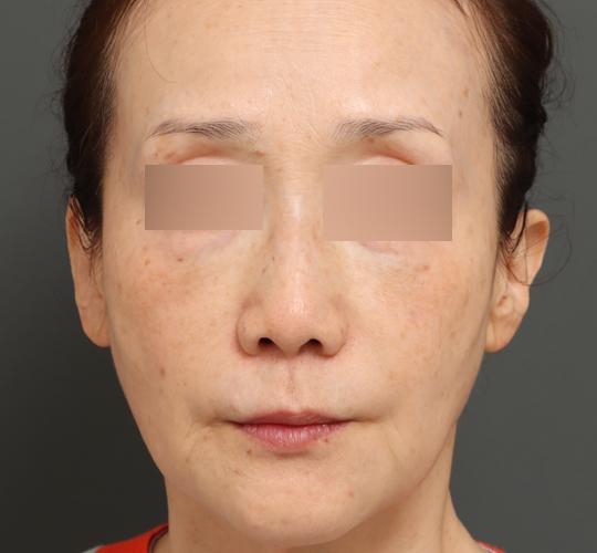 60代女性のエラ・アゴ・小顔 After 症例写真