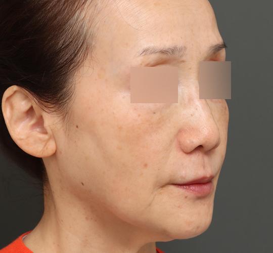 60代女性のボルニューマー After 症例写真