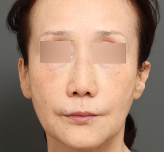 60代女性のエラ・アゴ・小顔 Before 症例写真