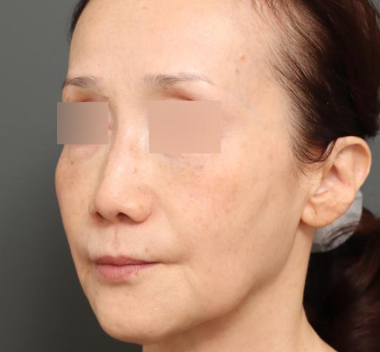 60代女性のボルニューマー Before 症例写真