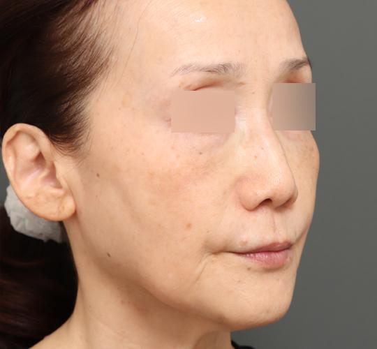 60代女性のボルニューマー Before 症例写真