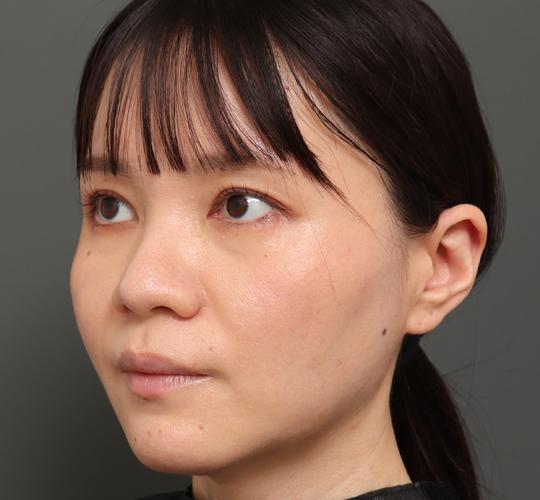 30代女性のハイブリッドリフト After 症例写真