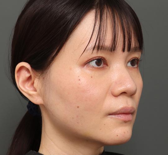 30代女性のボトックス(小顔) After 症例写真