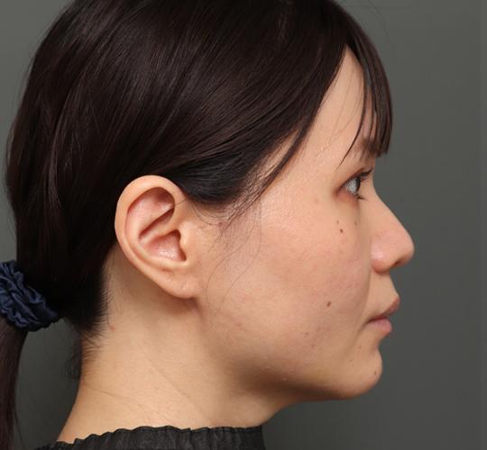 30代女性のハイブリッドリフト After 症例写真