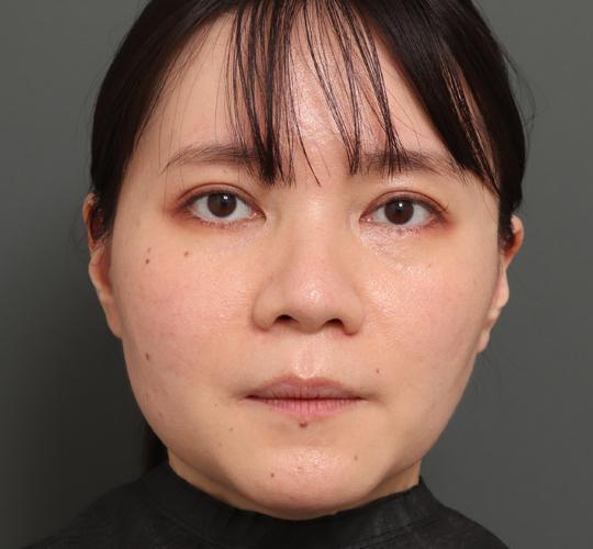 30代女性のハイブリッドリフト Before 症例写真