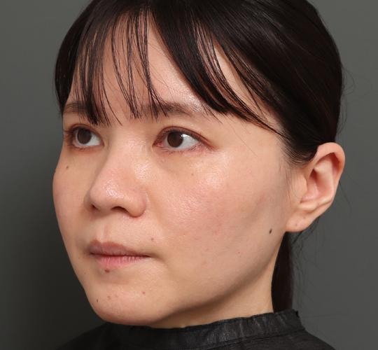 30代女性のハイブリッドリフト Before 症例写真