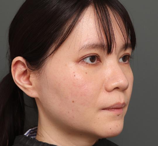 30代女性のボトックス(小顔) Before 症例写真