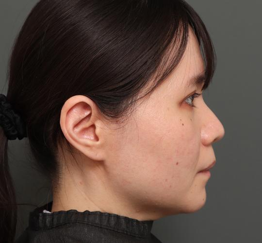 30代女性のハイブリッドリフト Before 症例写真