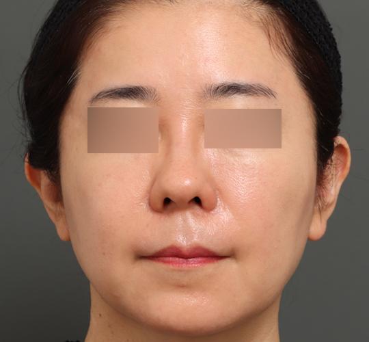 50代女性のエラ・アゴ・小顔 After 症例写真