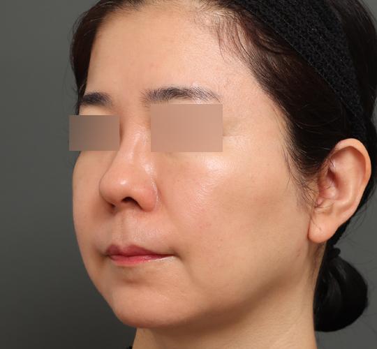 50代女性のボルニューマー After 症例写真