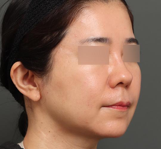 50代女性のボルニューマー After 症例写真