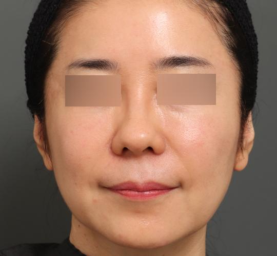 50代女性のエラ・アゴ・小顔 Before 症例写真