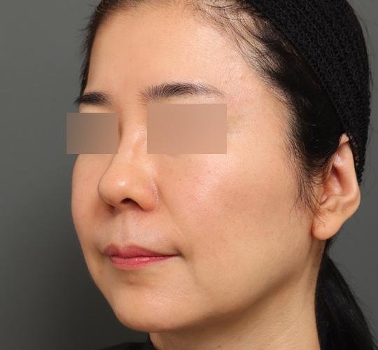 50代女性のボルニューマー Before 症例写真