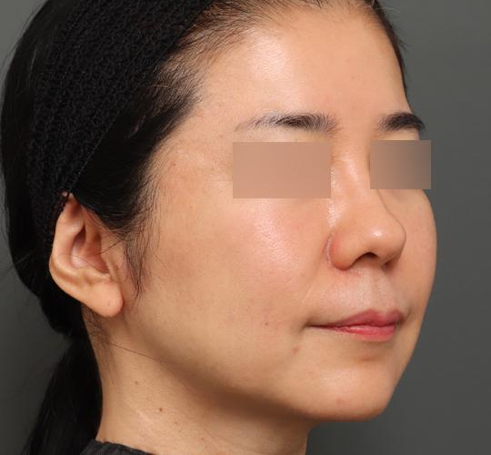 50代女性のボルニューマー Before 症例写真