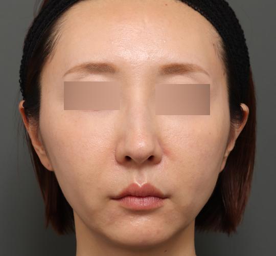 40代女性のエラ・アゴ・小顔 After 症例写真