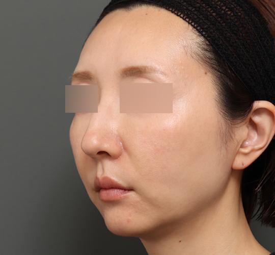 40代女性のボルニューマー After 症例写真