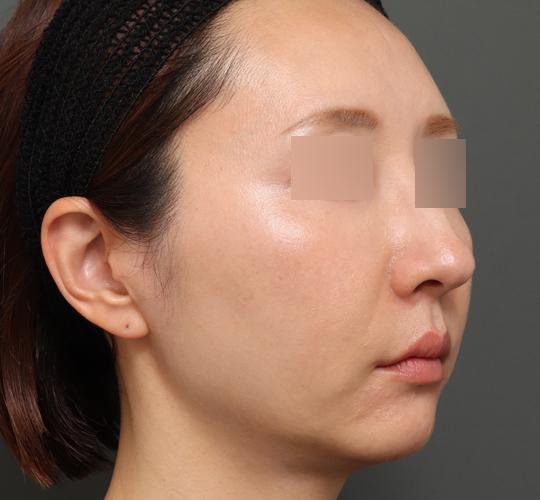 40代女性のボルニューマー After 症例写真