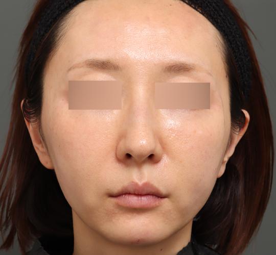40代女性のエラ・アゴ・小顔 Before 症例写真