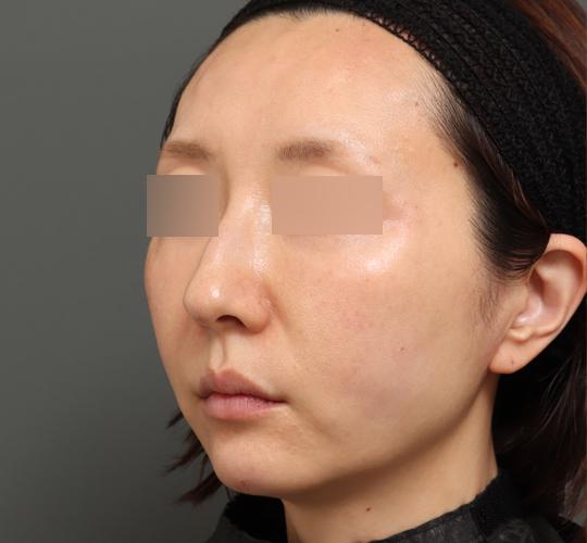 40代女性のボルニューマー Before 症例写真