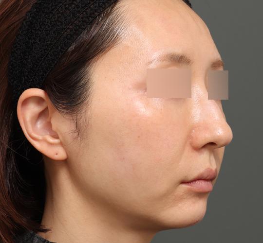 40代女性のボルニューマー Before 症例写真