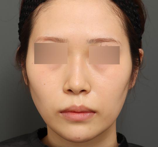 20代女性のバッカルファット除去 After 症例写真