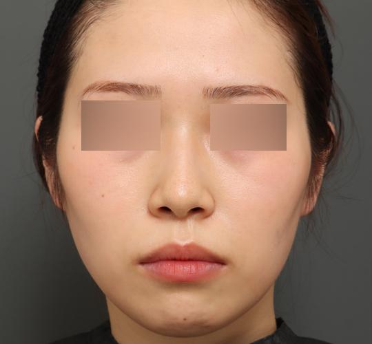 20代女性のバッカルファット除去 Before 症例写真