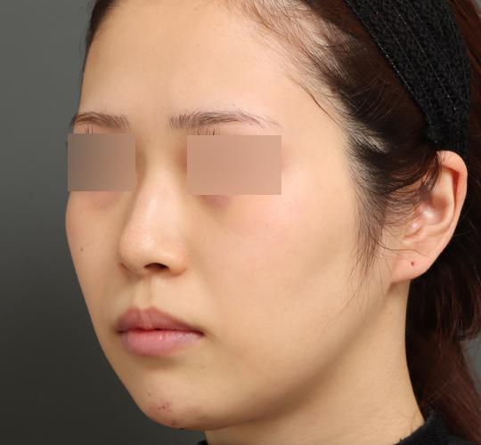 20代女性のバッカルファット除去 Before 症例写真